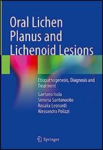 Oral Lichen Planus and Lichenoid Lesions: Etiopathogenesis, Diagnosis and Treatment